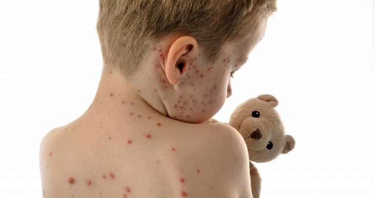 Situación de Sarampión en América, riesgo de reintroducción en Argentina